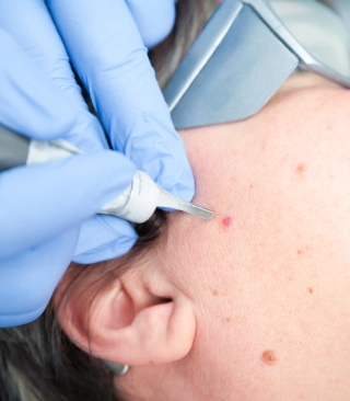 Mole-removal-image