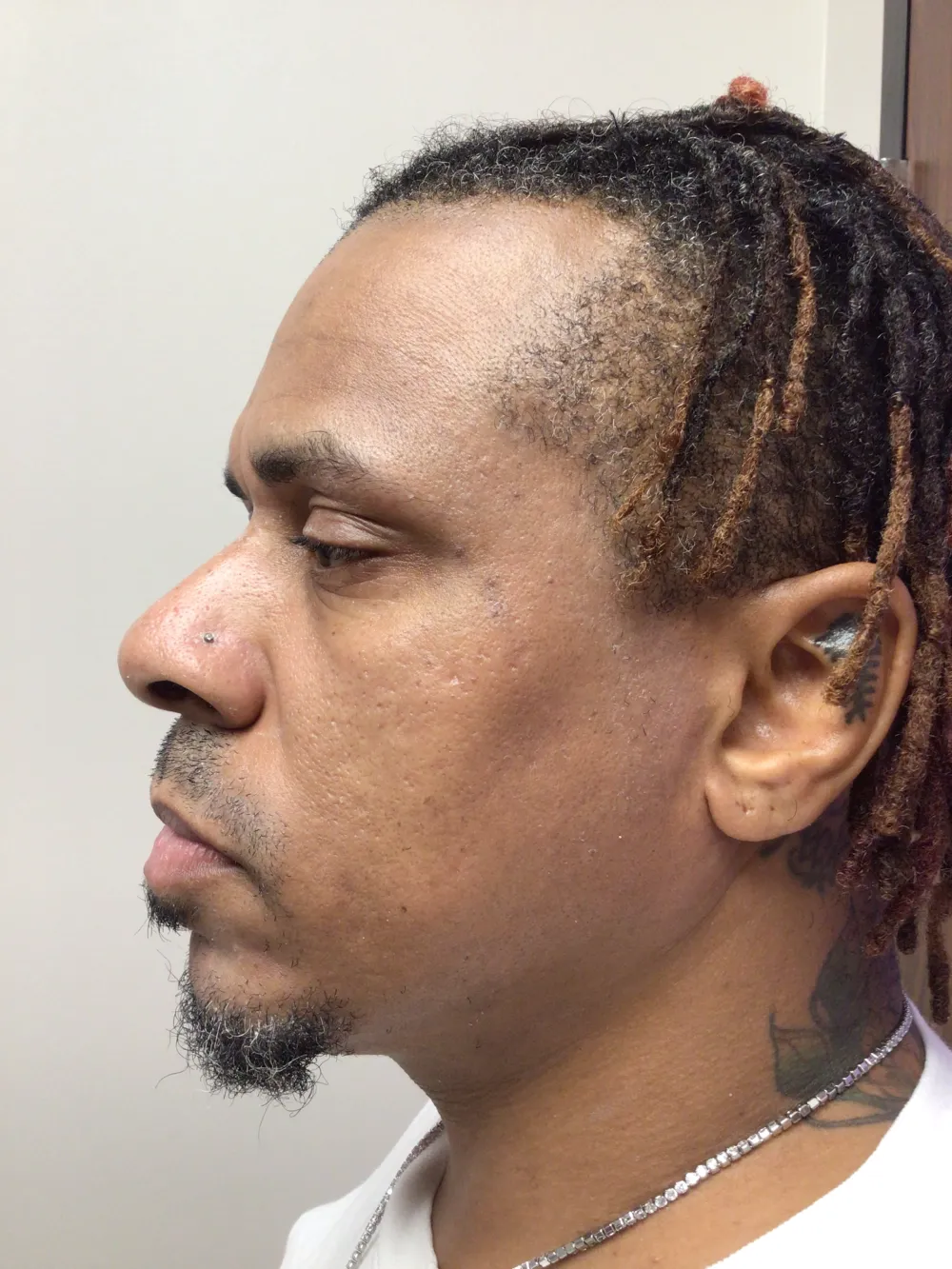 12_21_2023 After – Facial – Left Face – 3RD SESSION – DWSM000 12_21_2023 After - Facial - Left Face - 3RD SESSION - DWSM000