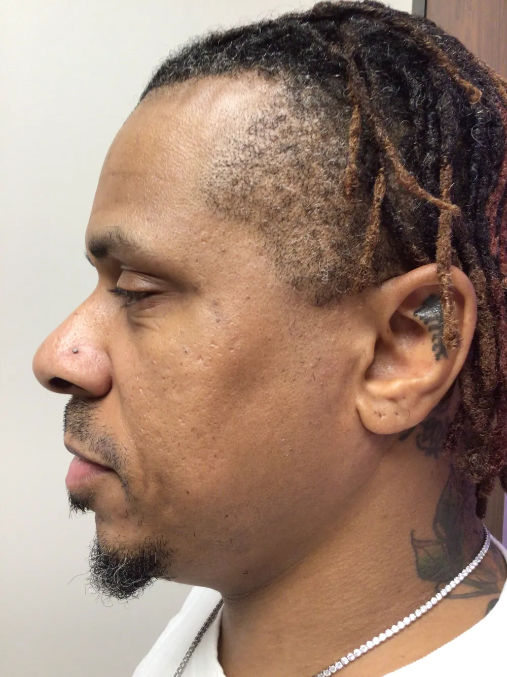 12_21_2023 Before – Facial – Left Face – 3RD SESSION – DWSM0000 12_21_2023 Before - Facial - Left Face - 3RD SESSION - DWSM0000