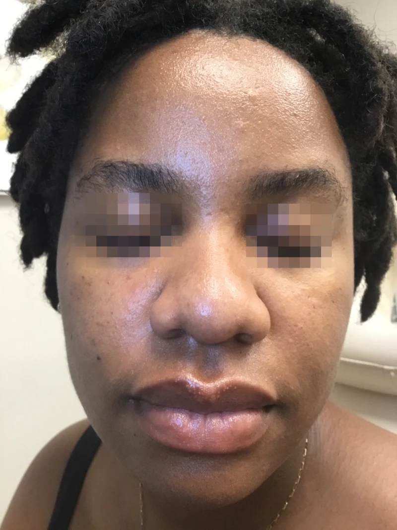 Acne-patient-1-dermatology-treatments-after