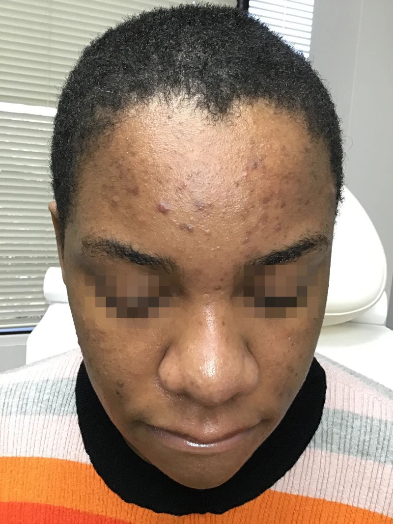 Acne-patient-1-dermatology-treatments-before