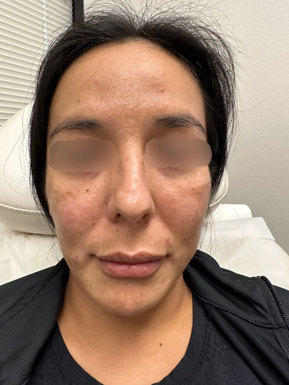 Facial-filler-patient-2-dermatology-treatments-after