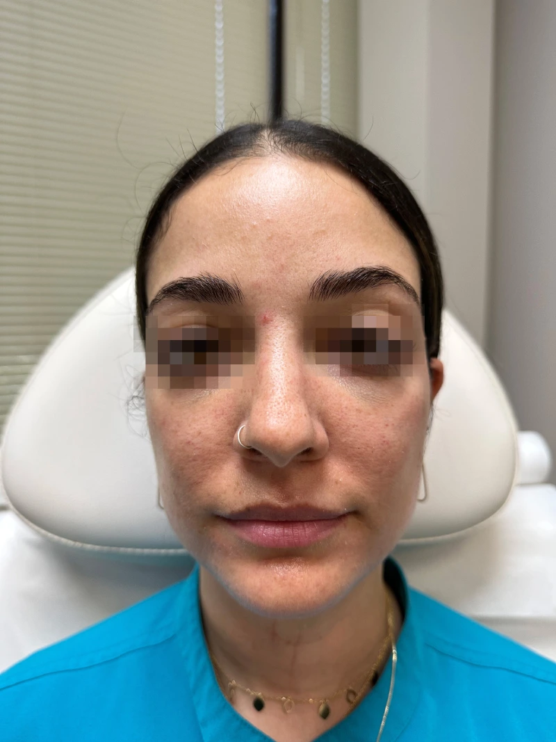 Facial-filler-patient-3-dermatology-treatments-after