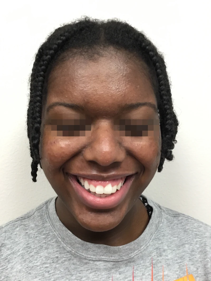 Acne-patient-2-dermatology-treatments-after