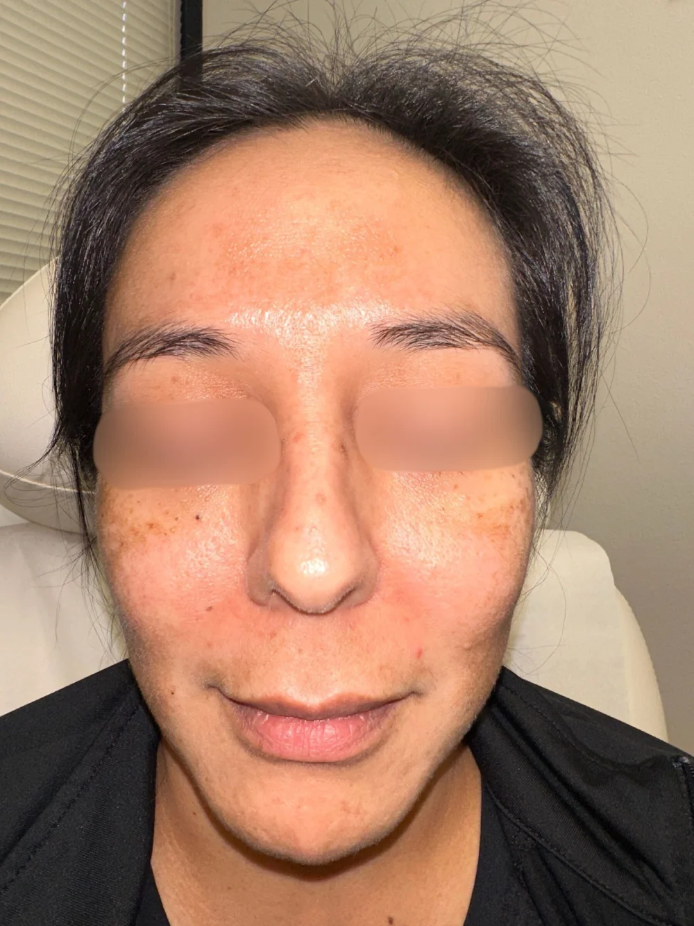 Facial-filler-patient-2-dermatology-treatments-before