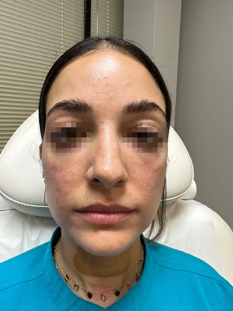 Facial-filler-patient-3-dermatology-treatments-before