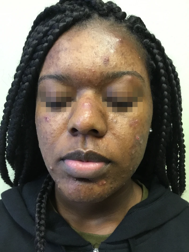 Acne-patient-2-dermatology-treatments-before