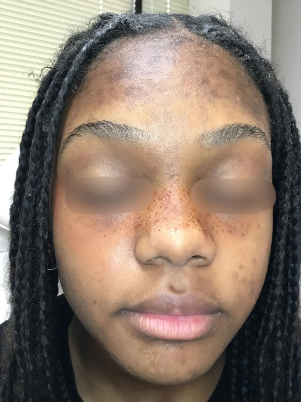 PATIENT 2 BEFORE (1)