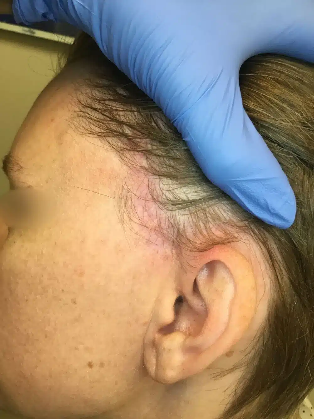 RHBL0000- Skin cancer removal AFTER