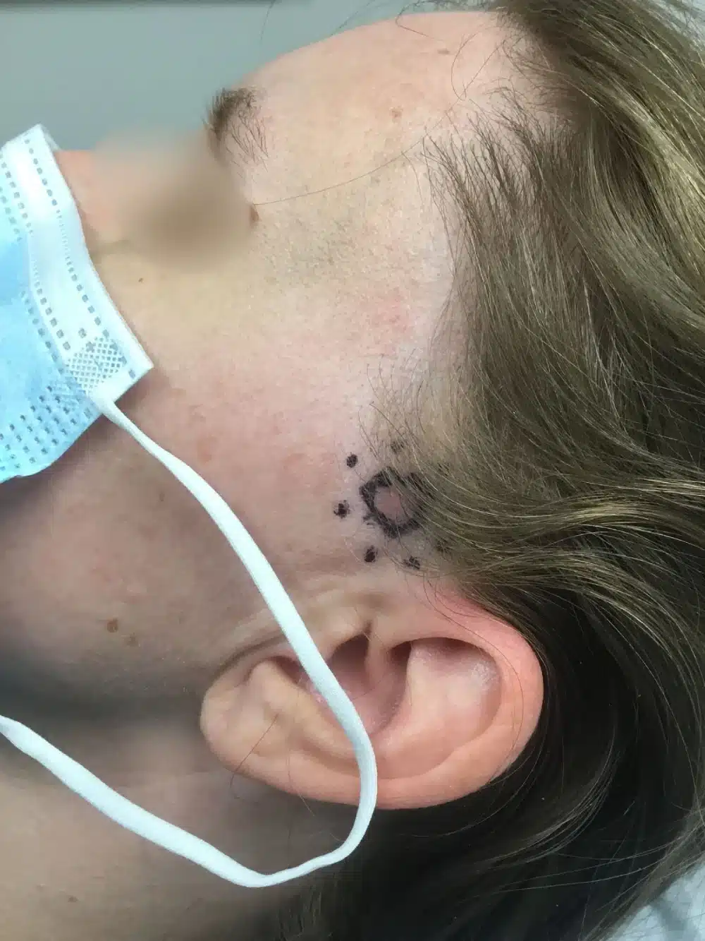 RHBL0000- Skin cancer removal BEFORE