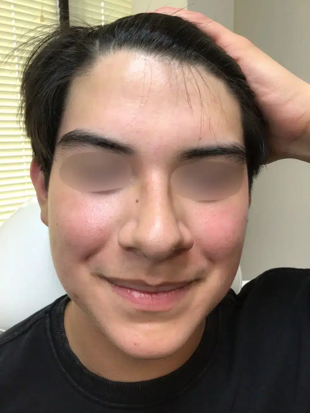 Acne-patient-3-dermatology-treatments-after