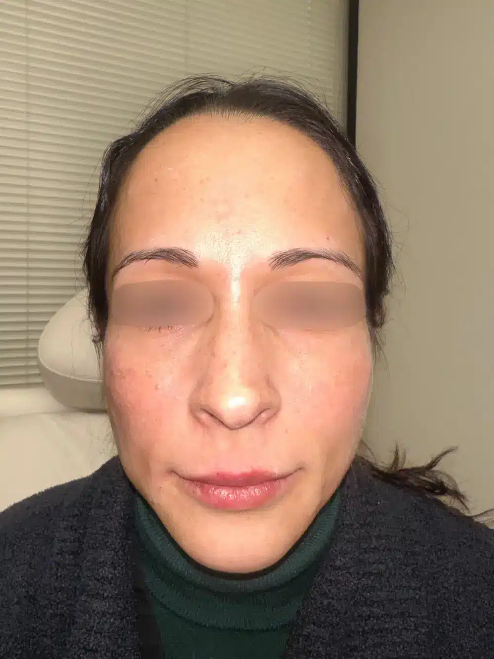 Full-face-rejuvenation-patient-2-dermatology-treatments-after