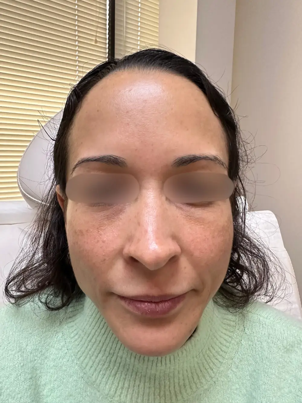 Full-face-rejuvenation-patient-2-dermatology-treatments-before