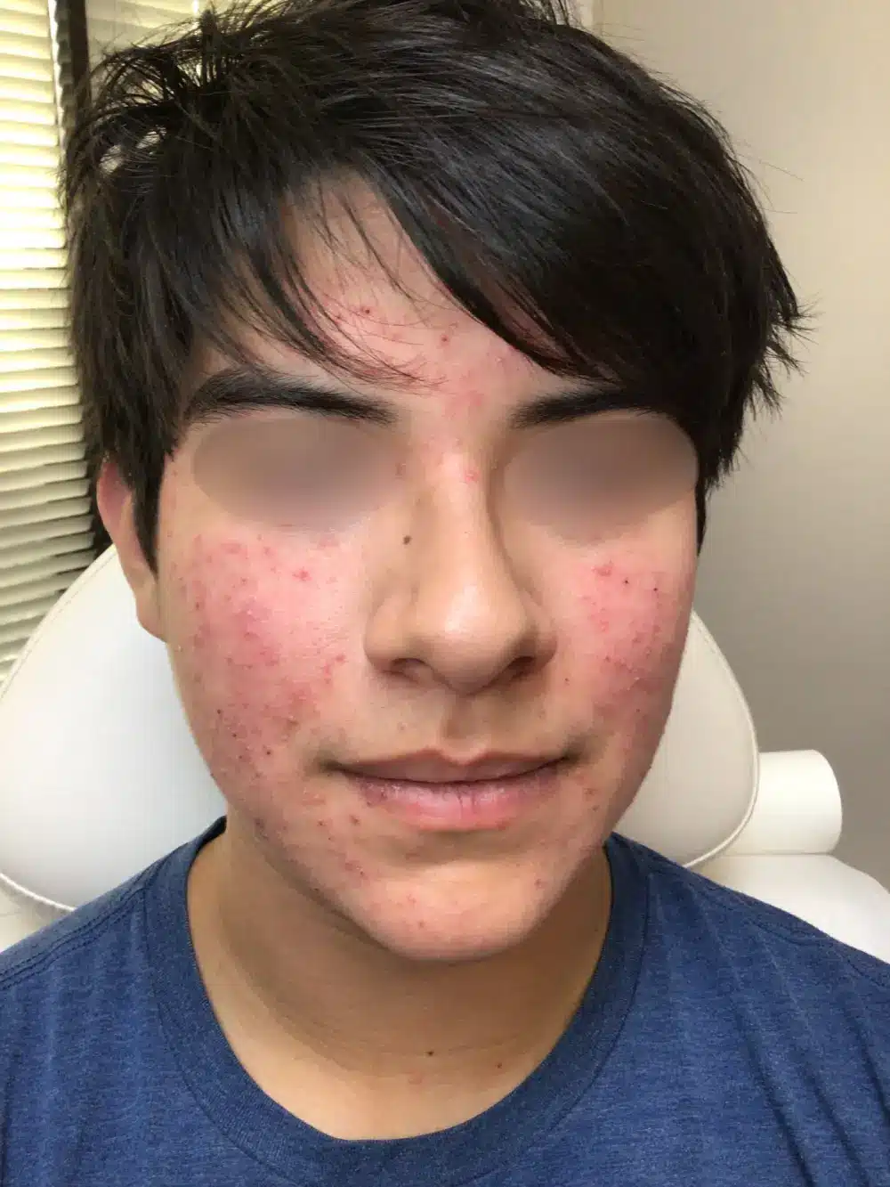 Acne-patient-3-dermatology-treatments-before