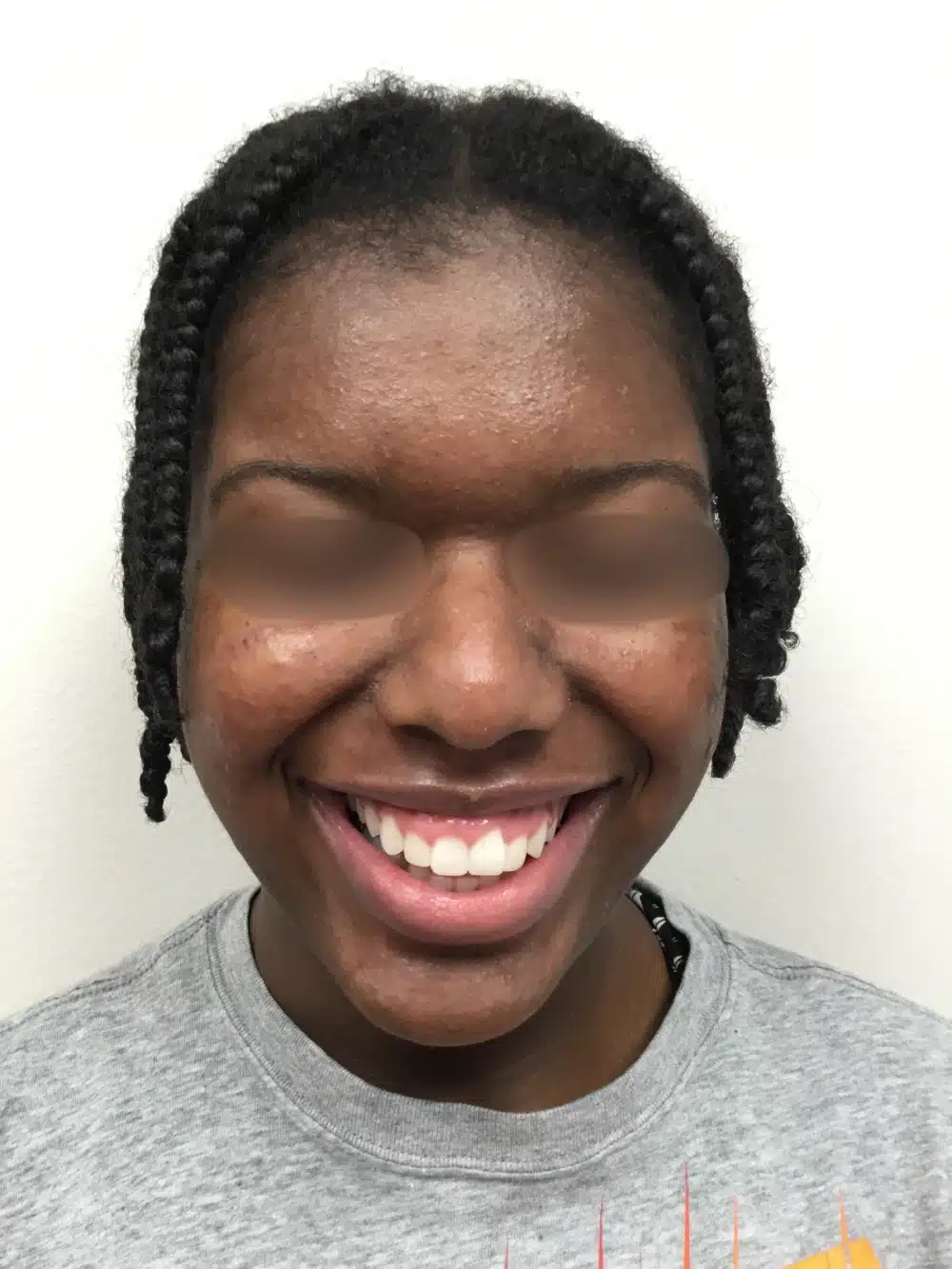 Acne-patient-2-dermatology-treatments-after