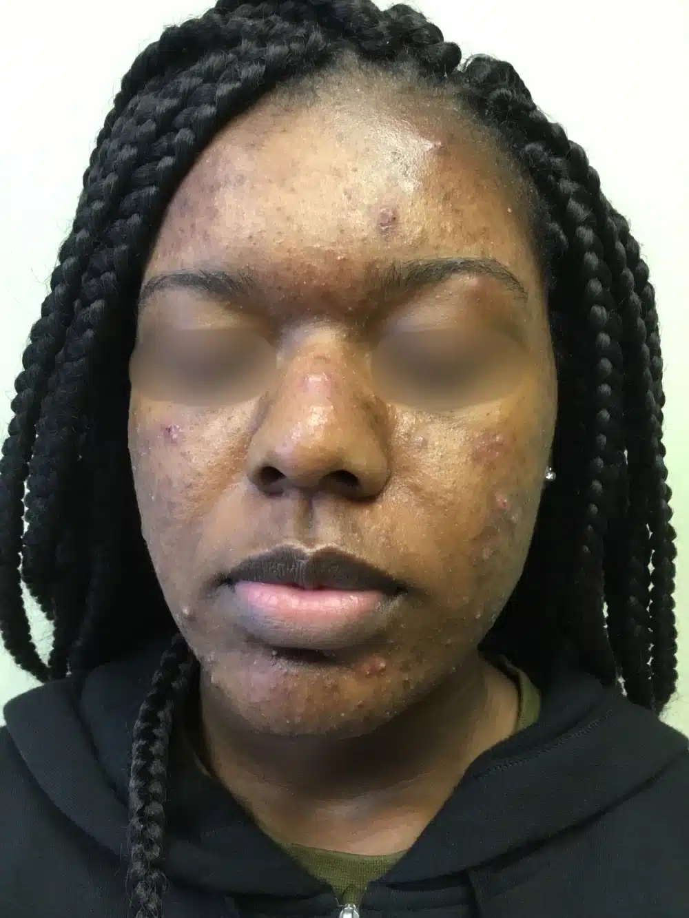 Acne-patient-2-dermatology-treatments-before