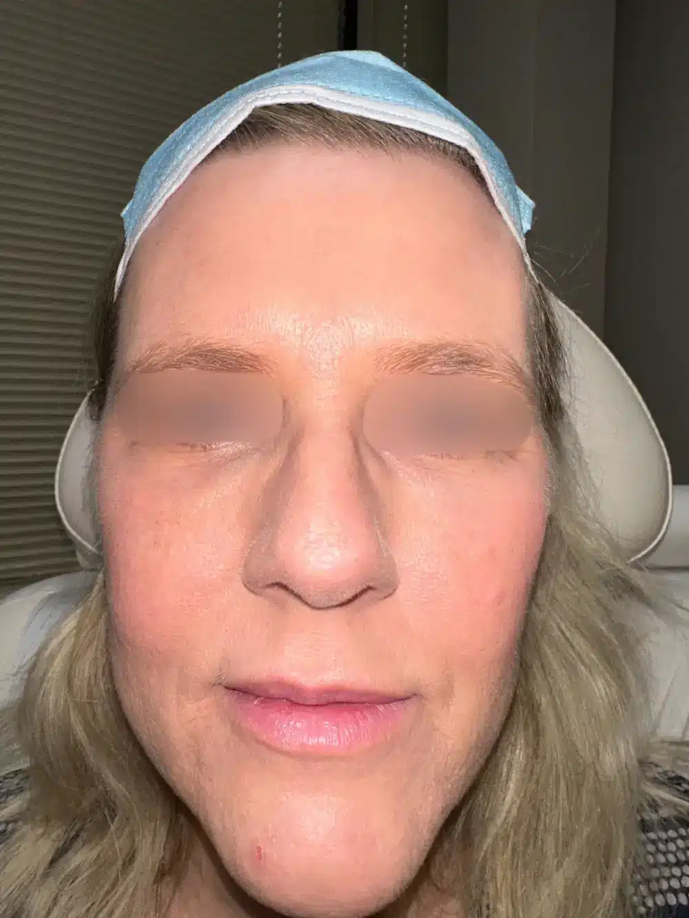 Full-face-rejuvenation-patient-3-dermatology-treatments-after