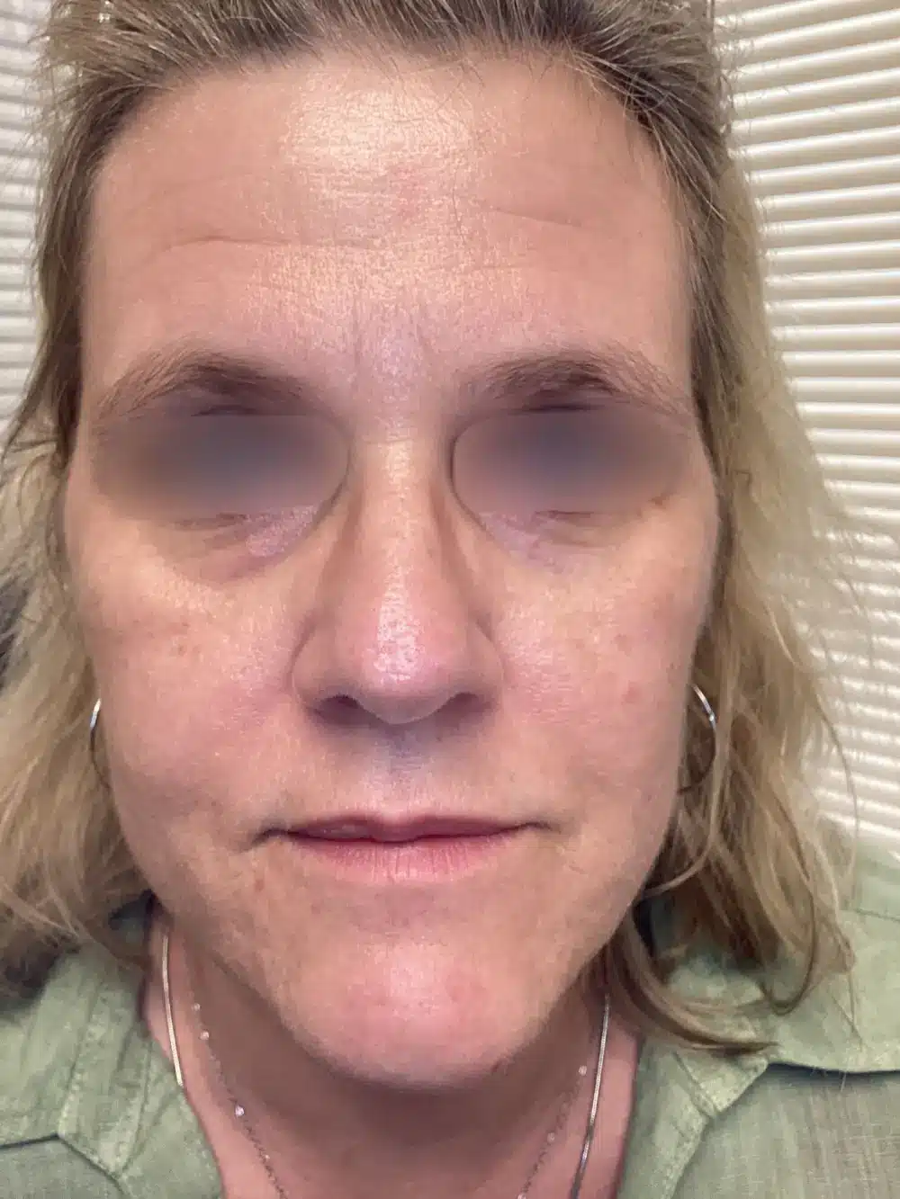 Full-face-rejuvenation-patient-3-dermatology-treatments-before