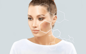 Melasma treatment