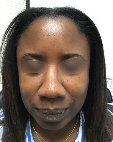 Clinical treatment of dynamic forehead lines and glabella frown lines using targeted neurotoxin injections. Post-treatment results showcase a refreshed, naturally smooth appearance while maintaining expressive facial movement across skin of color biology