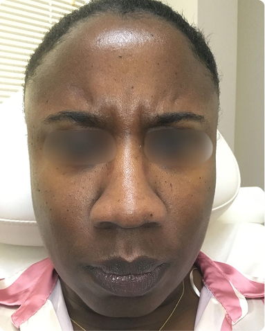 Clinical treatment of dynamic forehead lines and glabella frown lines using targeted neurotoxin injections. Post-treatment results showcase a refreshed, naturally smooth appearance while maintaining expressive facial movement across skin of color biology