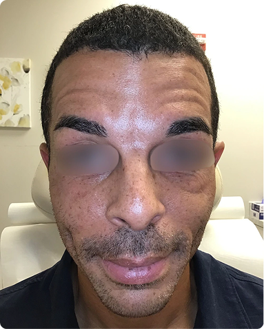 Correction of prominent forehead furrows and brow lines via precise neurotoxin dosing. The outcome demonstrates significant softening of deep dynamic wrinkles and a rested, balanced upper face contour tailored to the patient’s unique structural anatomy.