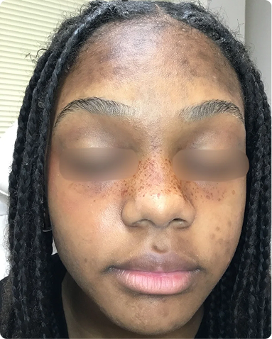 Advanced clinical chemical peel treatment targeting facial hyperpigmentation, post-inflammatory erythema, and active acne lesions. The post-treatment outcome demonstrates significant clearing of epidermal pigmentation, uniform skin tone, and refined skin texture across skin of color biology.