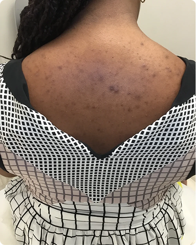 Targeted medical-grade chemical peeling for trunkal acne and extensive post-inflammatory hyperpigmentation on the back. The clinical progression showcases deep follicular clearing, a drastic reduction in dark spots, and smooth, restored skin contours.