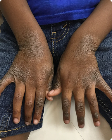 Dermatologist-led management of severe pediatric atopic dermatitis manifesting as prominent lichenification, hyperpigmentation, and xerosis on the hands and wrists. Post-treatment results demonstrate restoration of the epidermal barrier, significant smoothing of skin texture, and clearance of chronic inflammation across skin of color biology.