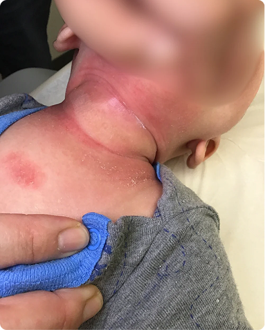 Targeted medical dermatology treatment for acute infantile eczema presenting with severe erythema and pruritic plaques on the neck folds. The clinical progression showcases complete clearance of active inflammatory flares and successfully restored, healthy skin barrier integrity.