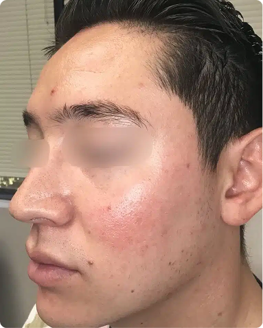 Integrative Acne Therapy for Chronic Breakouts