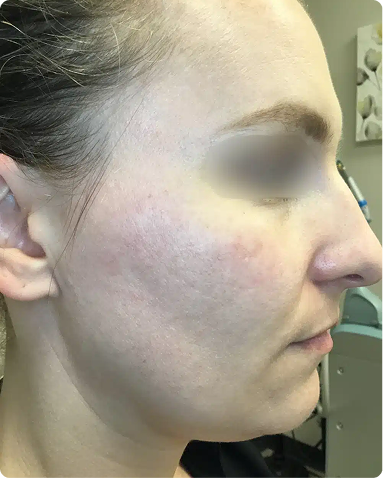 Dermatologist-led integrative treatment managing chronic rosacea flares and localized skin inflammation. The clinical progression demonstrates structural healing of the epidermal barrier, minimized redness, and beautifully balanced skin sensitivity using a specialized whole-body medical approach.