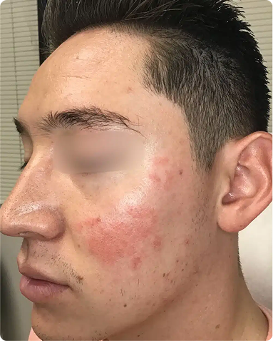 Comprehensive integrative dermatology treatment for erythematotelangiectatic rosacea. The post-treatment results showcase a dramatic reduction in chronic facial erythema, calmed vascular flushing, and restored skin barrier health through an integrated clinical methodology