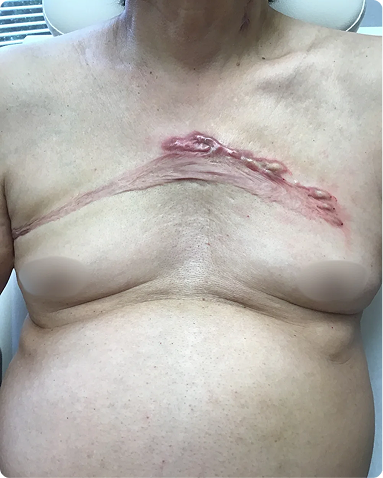 Advanced medical dermatology treatment for a large, raised chest keloid scar. The post-treatment outcome demonstrates highly successful flattening of the hypertrophic scar tissue, significant reduction in erythema, and minimized structural tension across the skin surface.