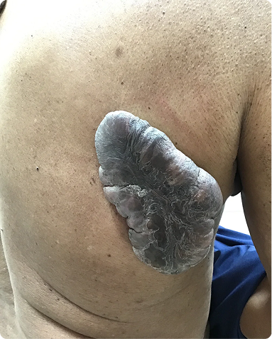 Specialized dermatologist-led keloid scar removal and multi-modality therapeutic remodeling on the back and upper torso. The clinical progression showcases a massive reduction in keloidal volume, flattened tissue margins, and improved skin contour uniformity.