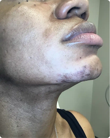 Advanced laser hair removal treatment targeting unwanted facial hair on the chin and jawline. The post-treatment result demonstrates a significant reduction in coarse hair density and a smoother skin surface optimized for skin of color biology.