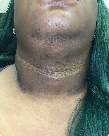 Targeted medical laser hair removal for the treatment of chin and neck pseudofolliculitis barbae and secondary post-inflammatory hyperpigmentation. The progression highlights excellent follicular clearing and restored skin uniformity across skin of color features.