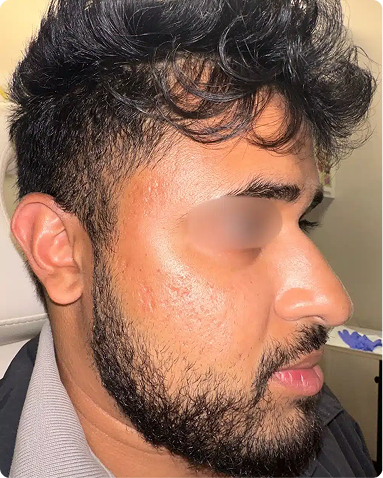 Advanced medical microneedling treatment for collagen induction therapy to address atrophic acne scarring and uneven skin texture. The post-treatment progression shows successful dermal remodeling, smoother skin contours, and improved structural tone across skin of color biology