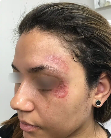 Targeted microneedling therapy for localized epidermal rejuvenation and texture correction. The clinical outcome demonstrates significant reduction of superficial irregularities and an overall refreshed, uniform skin texture profile