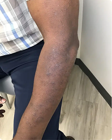Advanced medical dermatology treatment for chronic plaque psoriasis on the upper extremities. The post-treatment outcome shows remarkable clearance of scaling, significant flattening of psoriatic plaques, and restored skin health tailored to skin of color biology.