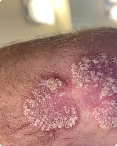 Targeted dermatologist-led therapy for the management of severe plaque psoriasis on the elbow. The clinical progression demonstrates complete reduction of thick silvery scales, markedly decreased erythema, and successfully calmed dermal inflammation