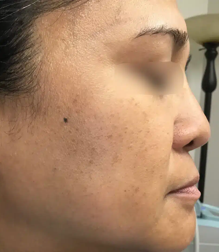 Professional dermaplaning treatment to manually exfoliate the stratum corneum and remove fine vellus hair. The post-procedure result showcases enhanced skin texture smoothness, increased cellular turnover, and a radiant complexion tailored to specialized aesthetic care