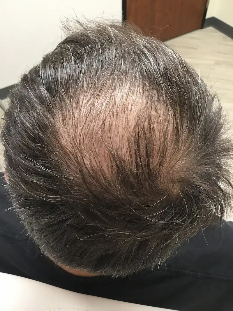 After 3 treatments of medical tattooing with minoxidil, dutasteride, and growth factors.