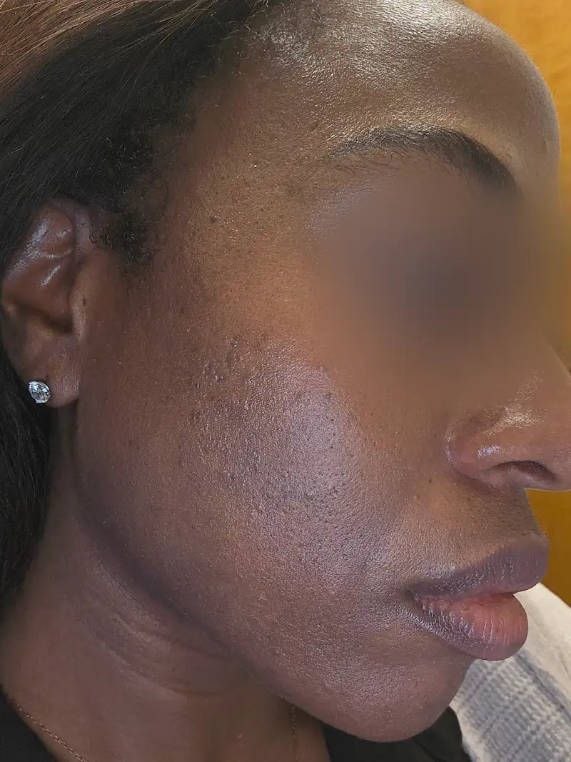 After integrative treatment of acne R side1