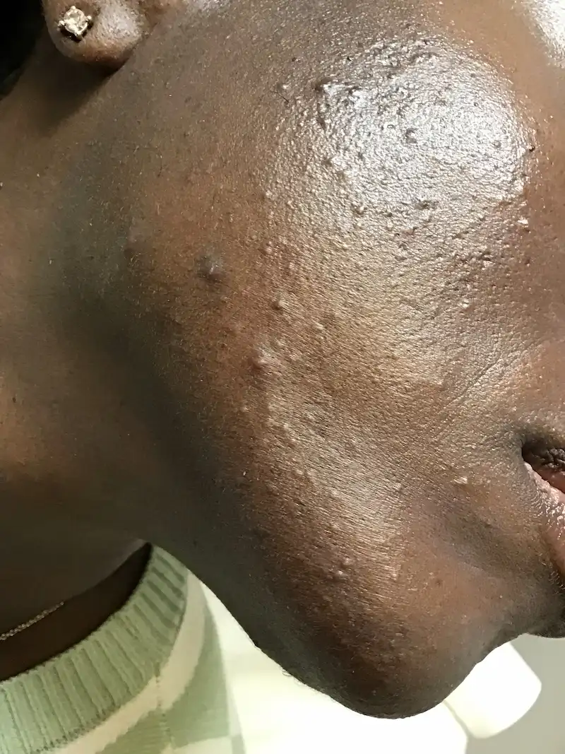 After 6 months of integrative treatment for acne, including gut and hormone workup. No cosmetic treatments were done