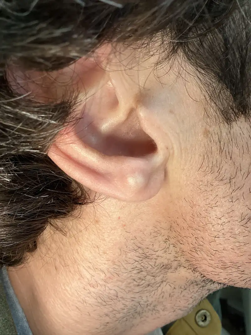 After removal of a 1 cm cyst on the earlobe