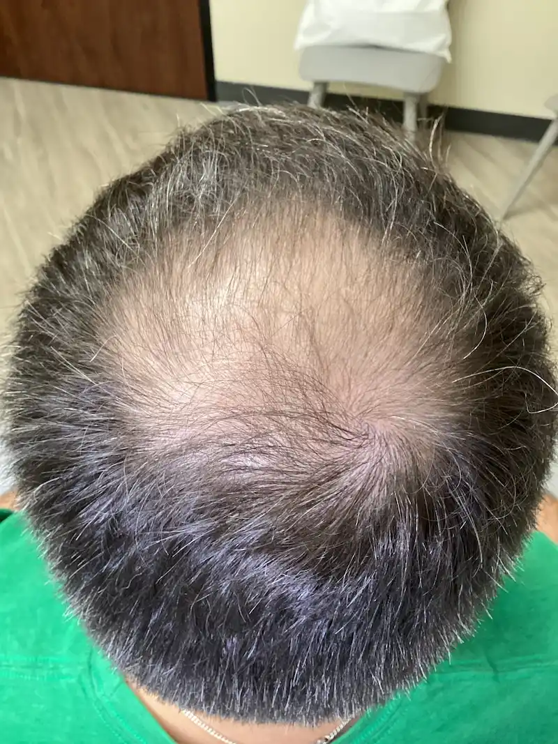 After 3 treatments of medical tattooing with minoxidil, dutasteride, and growth factors.