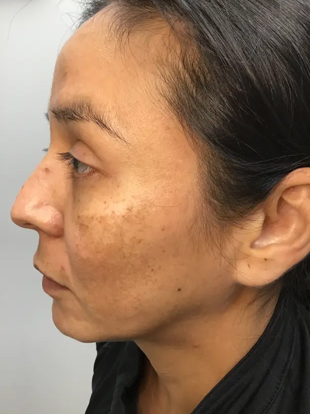L Face Before medical tattooing for melasma
