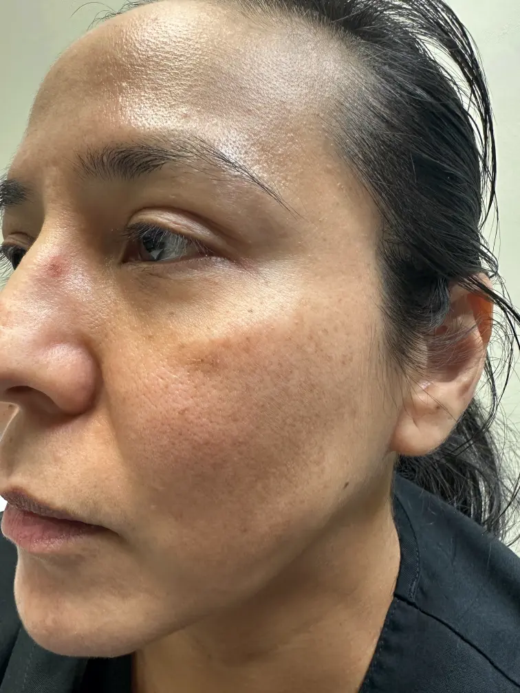 L face after medical tattooing for melasma