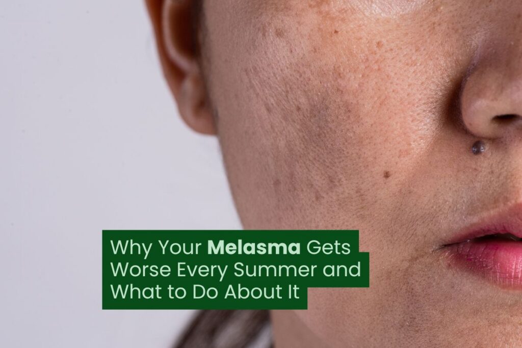 Why Your Melasma Gets Worse Every Summer and What to Do About It